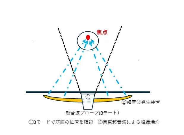 USガイド下HIFU（USgHIFU）とは