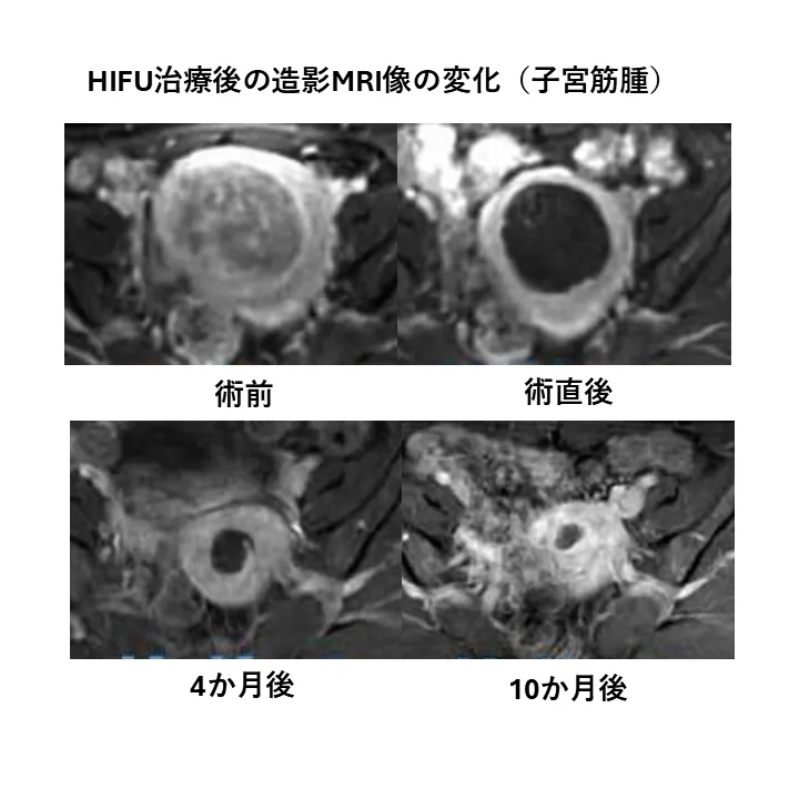 病変体積の減少