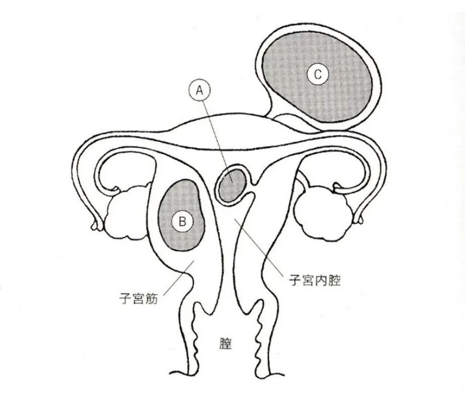 子宮筋腫のタイプと手術アプローチ