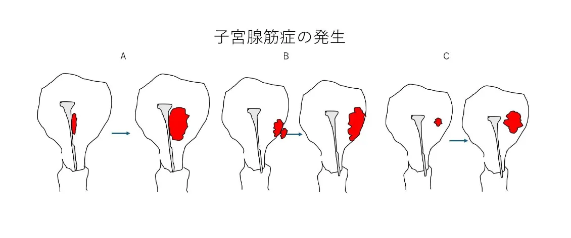 子宮腺筋症の発生